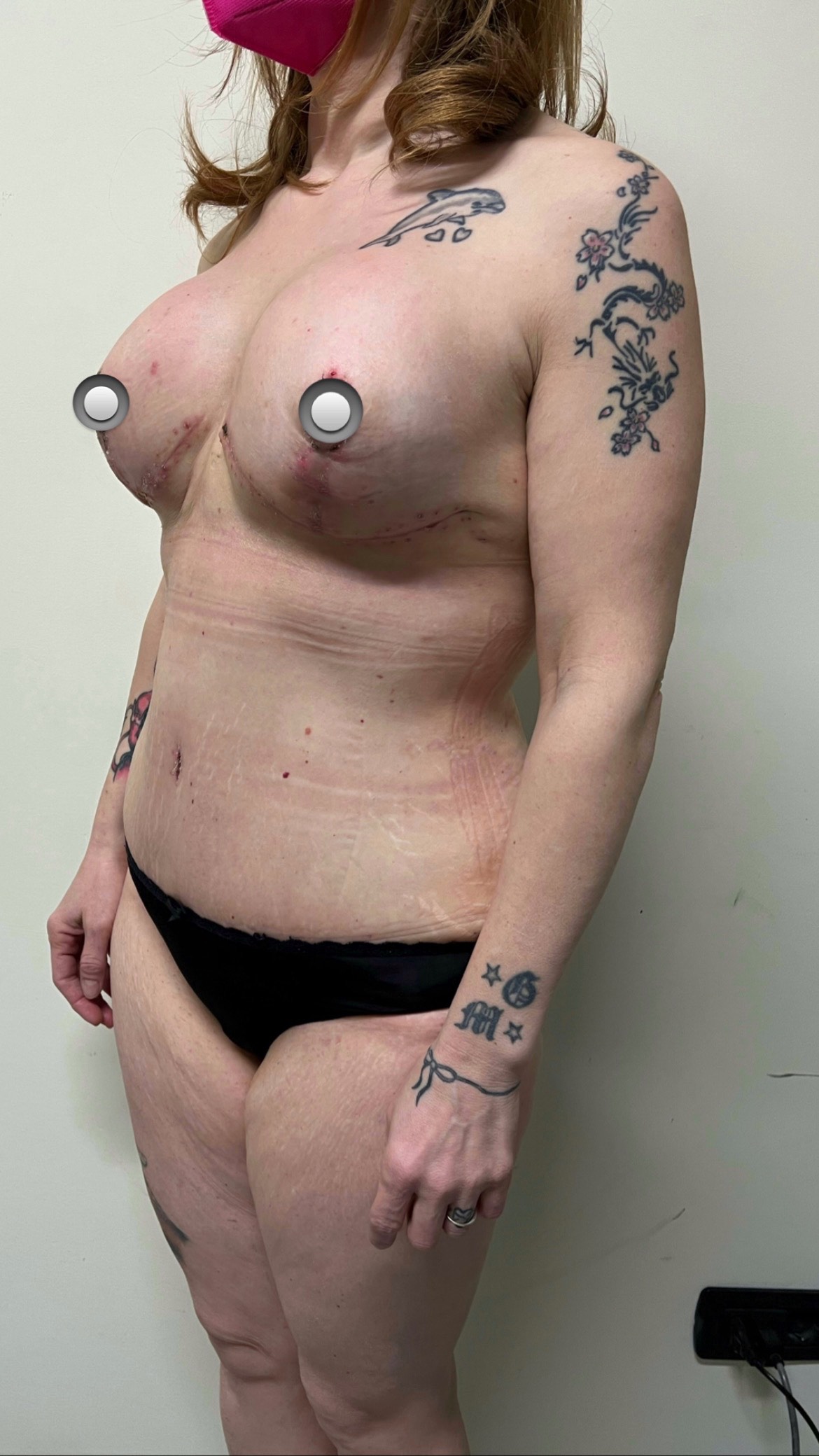 Mommy makeover addominoplastica + mastopessi con protesi effettuato dal dottore medico chirurgo Gary Gambassi