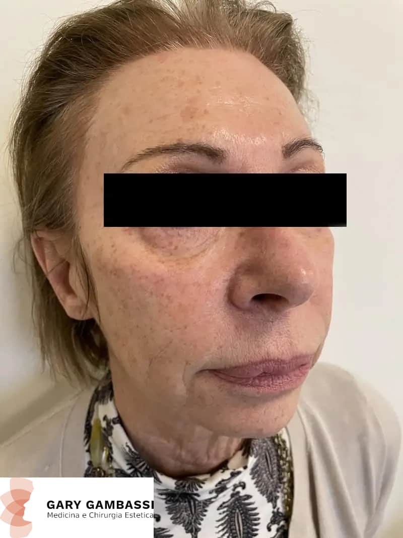 gary gambassi il miglior chirurgo plastico a Milano Peeling chimico - trattamento anti macchie