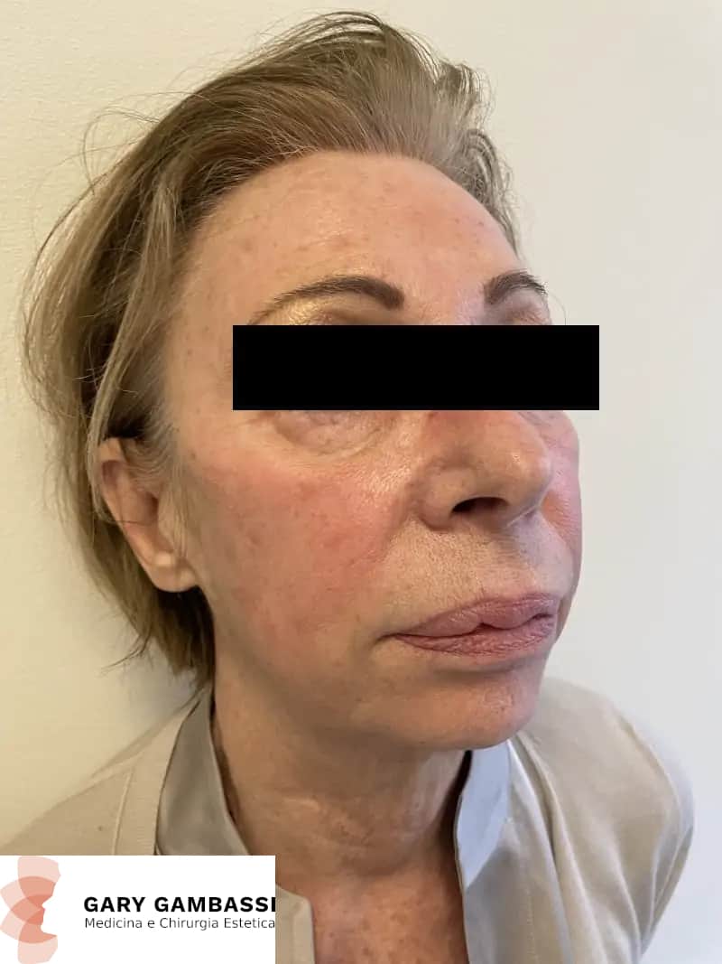 gary gambassi il miglior chirurgo plastico a Milano Peeling chimico - trattamento anti macchie