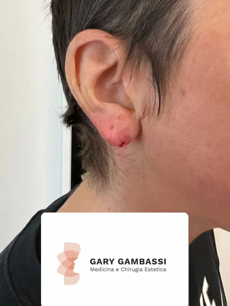 piccola chirurgia gary gambassi il miglior chirurgo plastico a Milano