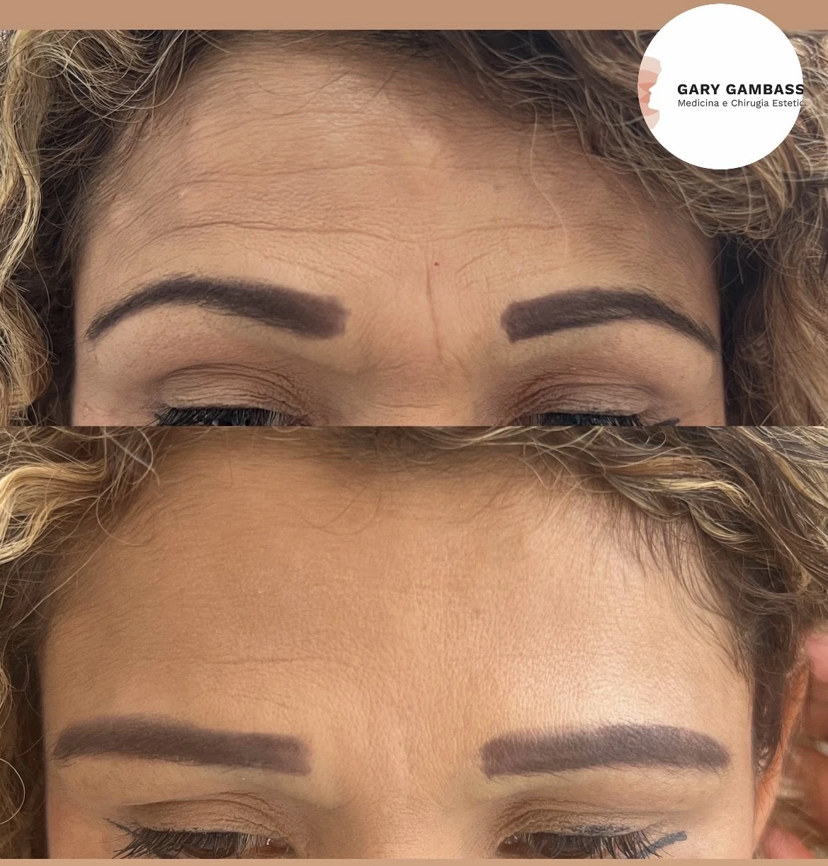 botox milano chirurgo estetico gary gambassi