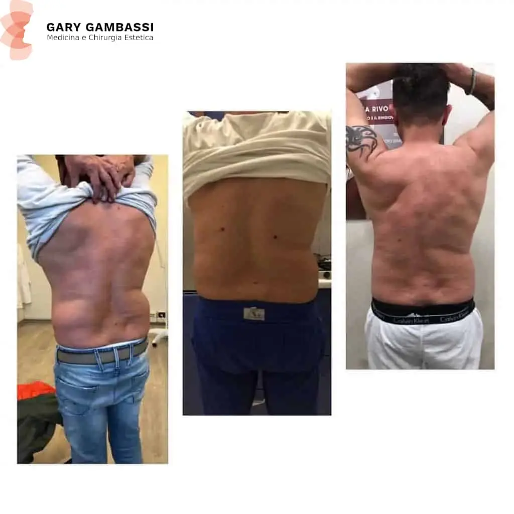 Liposuzione maschile fianchi effettuata dal dottore medico chirurgo Gary Gambassi